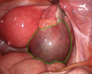 Chist folicular laparoscopie