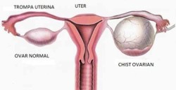 chist ovarian